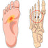 Stressfractuur preventie